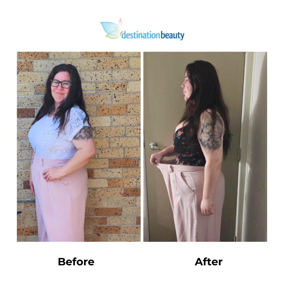 Stefanie had gastric sleeve surgery in Thailand